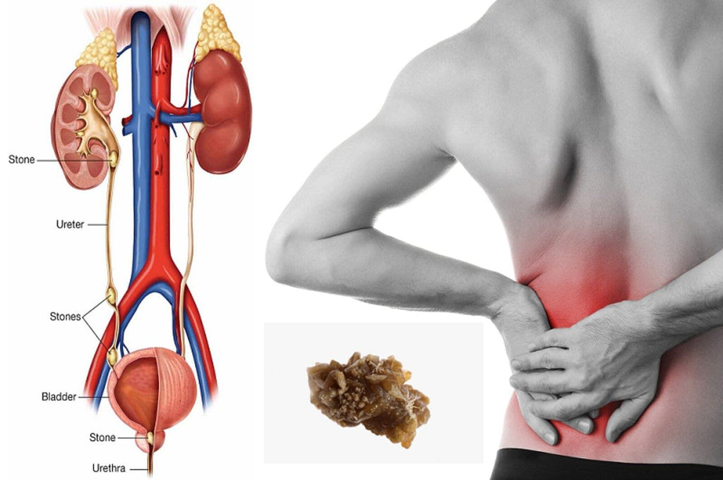 Improve Water Intake and Avoid Kidney Stones - Coldest