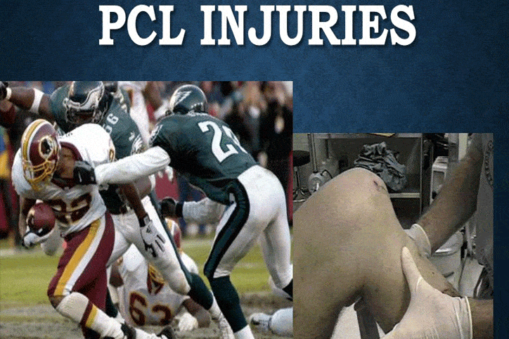 Posterior Cruciate Ligament (PCL) Injury – Causes, Systems and Treatment - Coldest