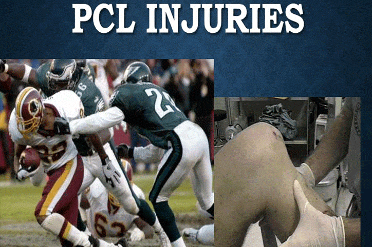 Posterior Cruciate Ligament (PCL) Injury – Causes, Systems And Treatme ...